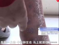 理疗床垫造成“二级烫伤”，厂家称糖尿病导致？