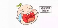 手足口病主要传播途径 手足口病怎么治疗