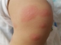 宝宝被蚊子咬了红肿特别大怎么办